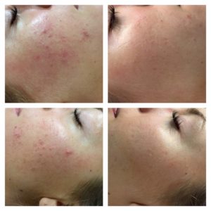 Behandling med Dermapen, microneedling på område med acne